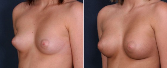 dr-saltz-breast-augmentation-54b
