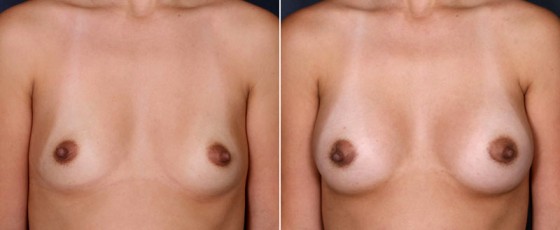 dr-saltz-breast-augmentation-55a