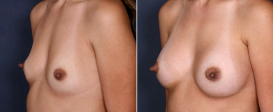 dr-saltz-breast-augmentation-55b