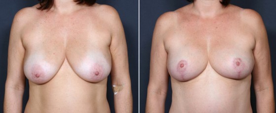 dr-saltz-breast-lift-01a