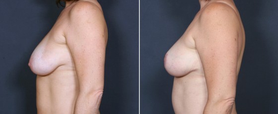 dr-saltz-breast-lift-01c
