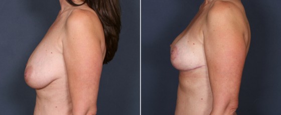 dr-saltz-breast-lift-02c