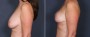 Dr. Saltz Breast Lift Patient 5