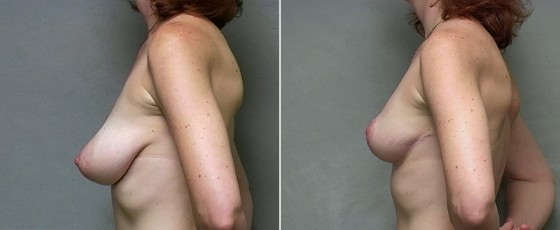 dr-saltz-breast-lift-06c