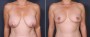 Dr. Saltz Breast Lift Patient 8