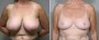 Dr. Saltz Breast Reduction Patient 1