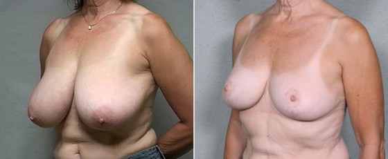 dr-saltz-breast-reduction-04b