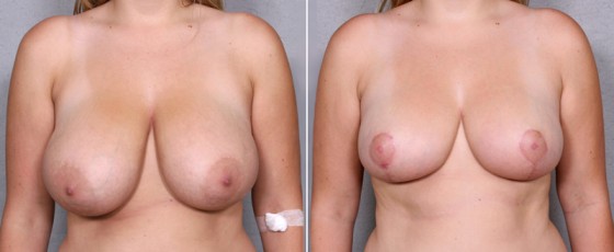 dr-saltz-breast-reduction-07a
