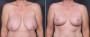 Dr. Saltz Breast Reduction Patient 3