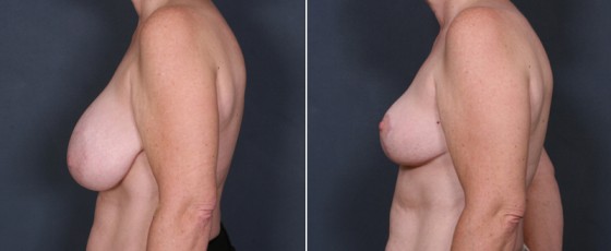 dr-saltz-breast-reduction-08c