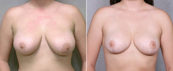 dr-saltz-breast-reduction-11a