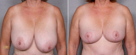 dr-saltz-breast-reduction-12a