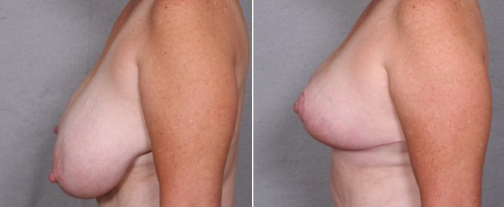 dr-saltz-breast-reduction-12c