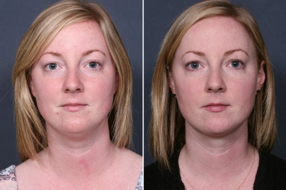 neck-lipo-101a-dr-brahme
