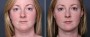 Dr. Brahme Neck Liposuction Patient 1