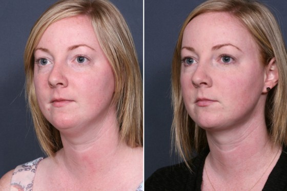 neck-lipo-101b-dr-brahme
