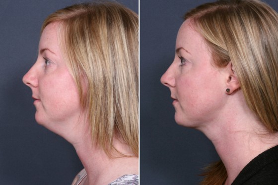 neck-lipo-101c-dr-brahme