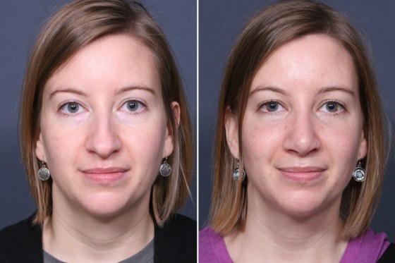 Dr. Grzeskiewicz Rhinoplasty Patient 1