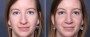 Dr. Grzeskiewicz Rhinoplasty Patient 1