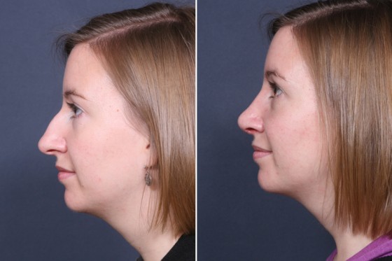 norm-Grzeskiewicz-rhinoplasty-101c